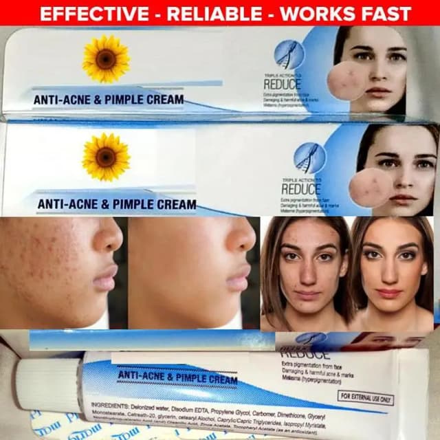 Acne Treatment Cream - Natural Formula for Clearer Complexion